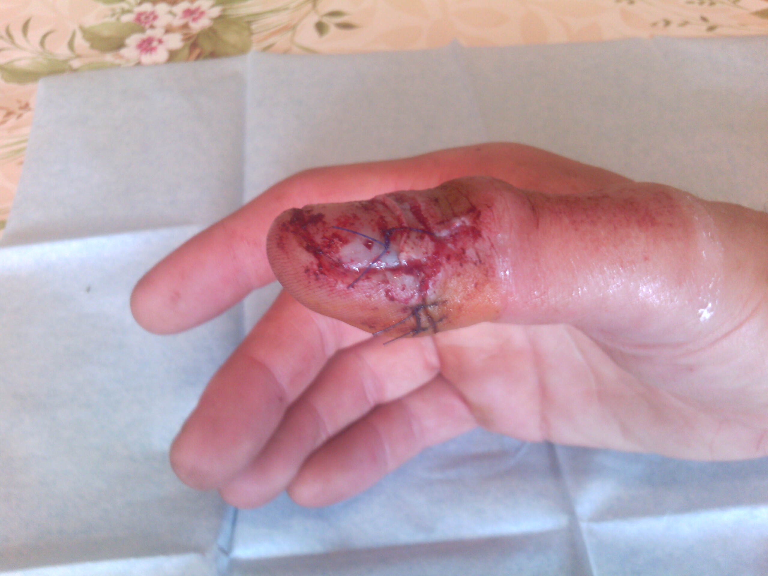 point de suture pouce point de suture pouce